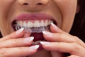 a lady is putting invisalign