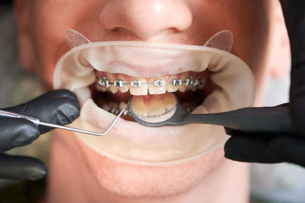dentist fixing patient's teeth