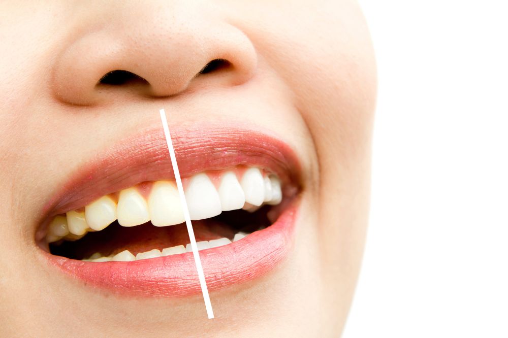 before and after teeth whitening treatment